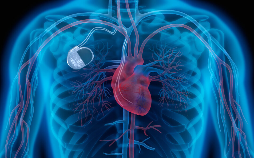 Herzschwäche – brauche ich einen CRT-Schrittmacher?